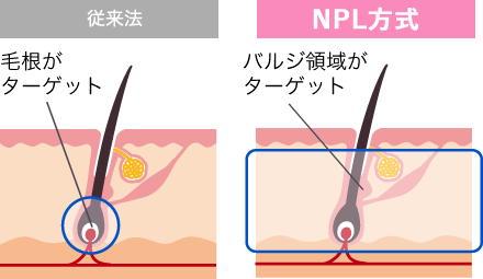 連射式ハイスピード脱毛機 RIOXY VICTORIA ヴィクトリア